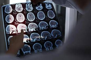 Rallentare l’Alzheimer con il litio, scoperta la ‘scintilla’ che innesca la patologia?