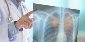 Tumori, nel 2050 i morti cancro supereranno i 18 milioni (+75%): lo studio su Lancet